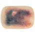 TraumaSim Self-Adhesive Large Haematoma